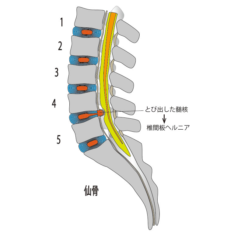 走る と 腰 が 痛い ヘルニア